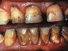 http://www.nyc.gov/html/doh/images/smoke/pr017-07-decaying-teeth.gif