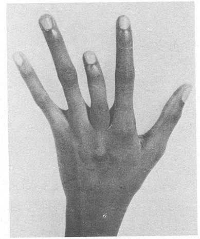 http://biology.kenyon.edu/slonc/gene-web/sickle_cell_project/shortened%20finger.jpg